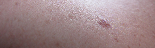 La aparición de manchas en la piel: cuándo preocuparse y cómo tratarlas