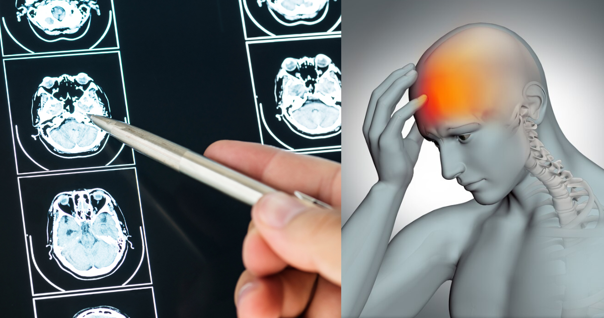 ¿Qué es un accidente cerebrovascular? Cuáles son sus señales de alerta y cómo evitar sus secuelas