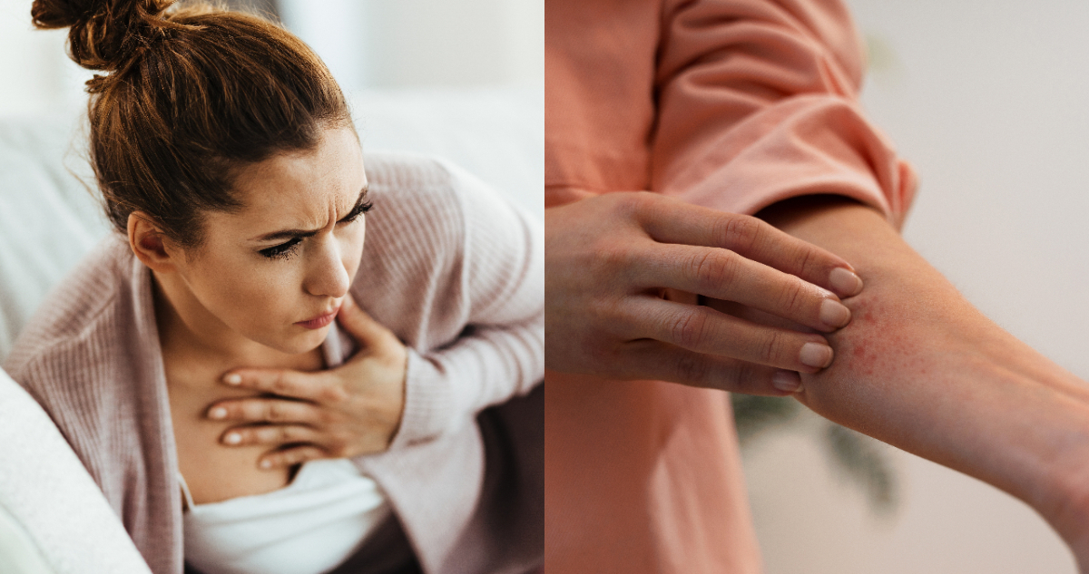 Reacción alérgica severa: cómo identificar sus síntomas a tiempo y qué hacer en una emergencia
